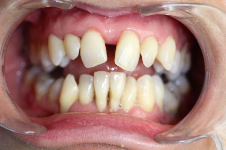 Malocclusion antérieure et hypoplasie maxillaires