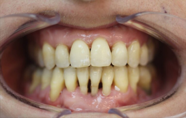 distraction palatine et avancée mandibulaire combinées avec des appareils orthodontiques