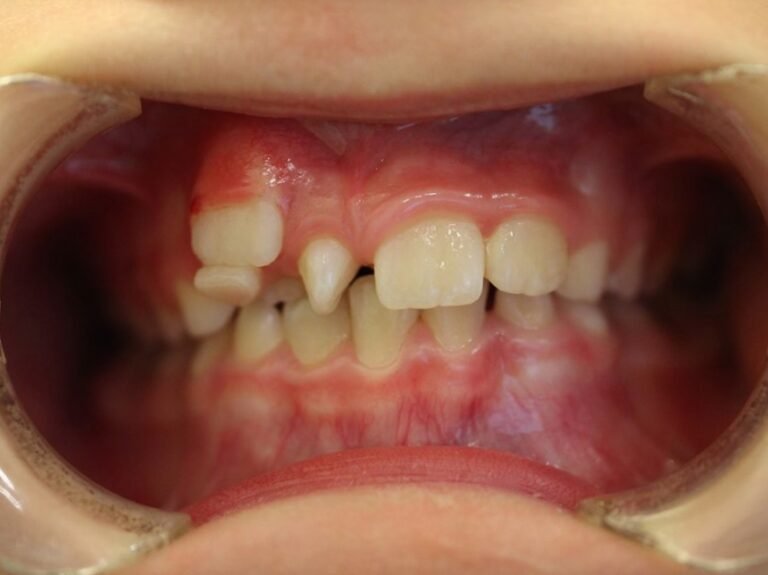 mésiodens en dentition mixte et perte d'espace pour l'éruption des canines permanentes inférieures