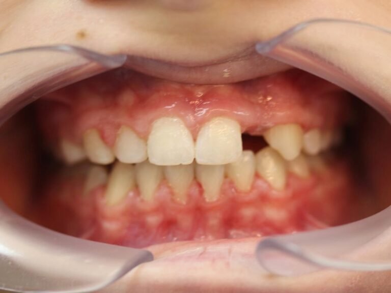 Traitement orthodontique pour corriger l'espace pour une dent manquante (implant)