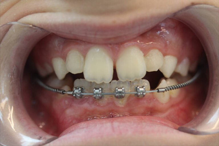 correction transposition dent