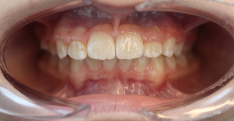 encombrement et hypoplasie maxillaire supérieure en dentition mixte