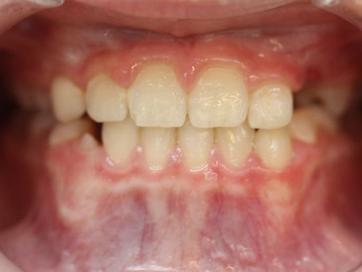correction classe III pendant la dentition mixte classe III