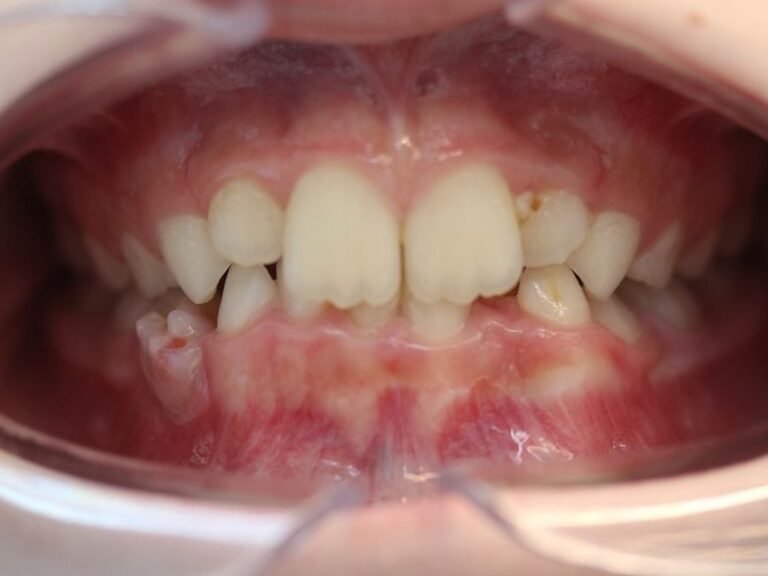 correction transposition dent permanente et supraclusion et encombrement