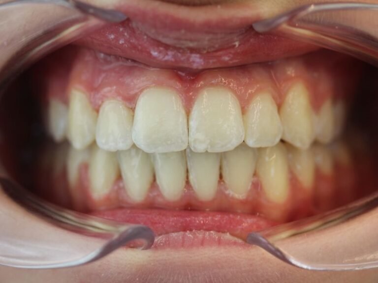 orthodontie et disjoncteur palatin rapide