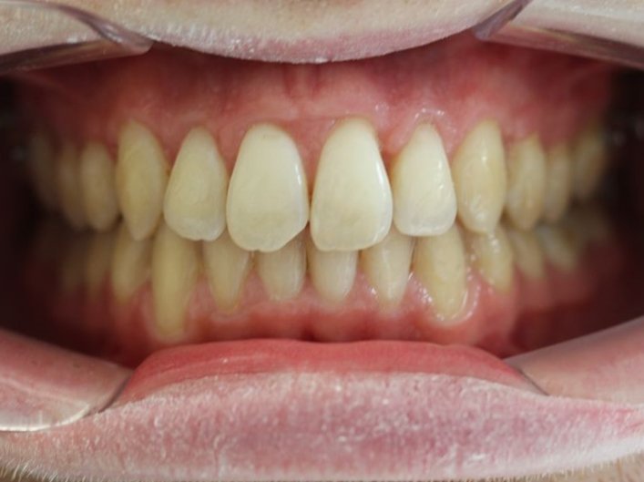 Invisalign et mini-vis