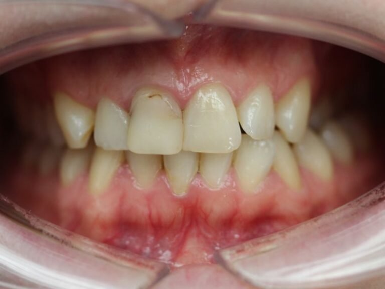 27-06-2023 Intra-oral Face Début