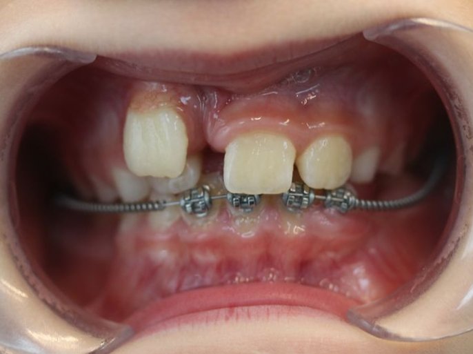 ablation mésiodens et correction encombrement