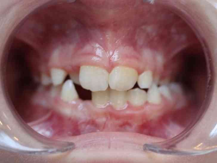 arc étroit et occlusion croisée pendant la dentition mixte