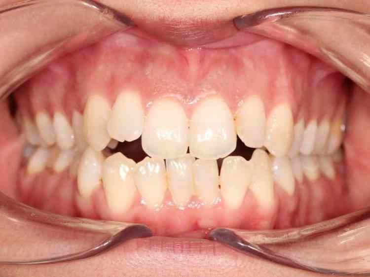 Open bite et supraclusion bilatérales - hypoplasie de la mâchoire maxillofaciale supérieure