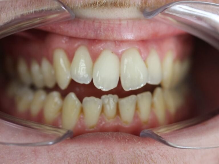 Occlusion ouverte et endognathie de la mâchoire supérieure