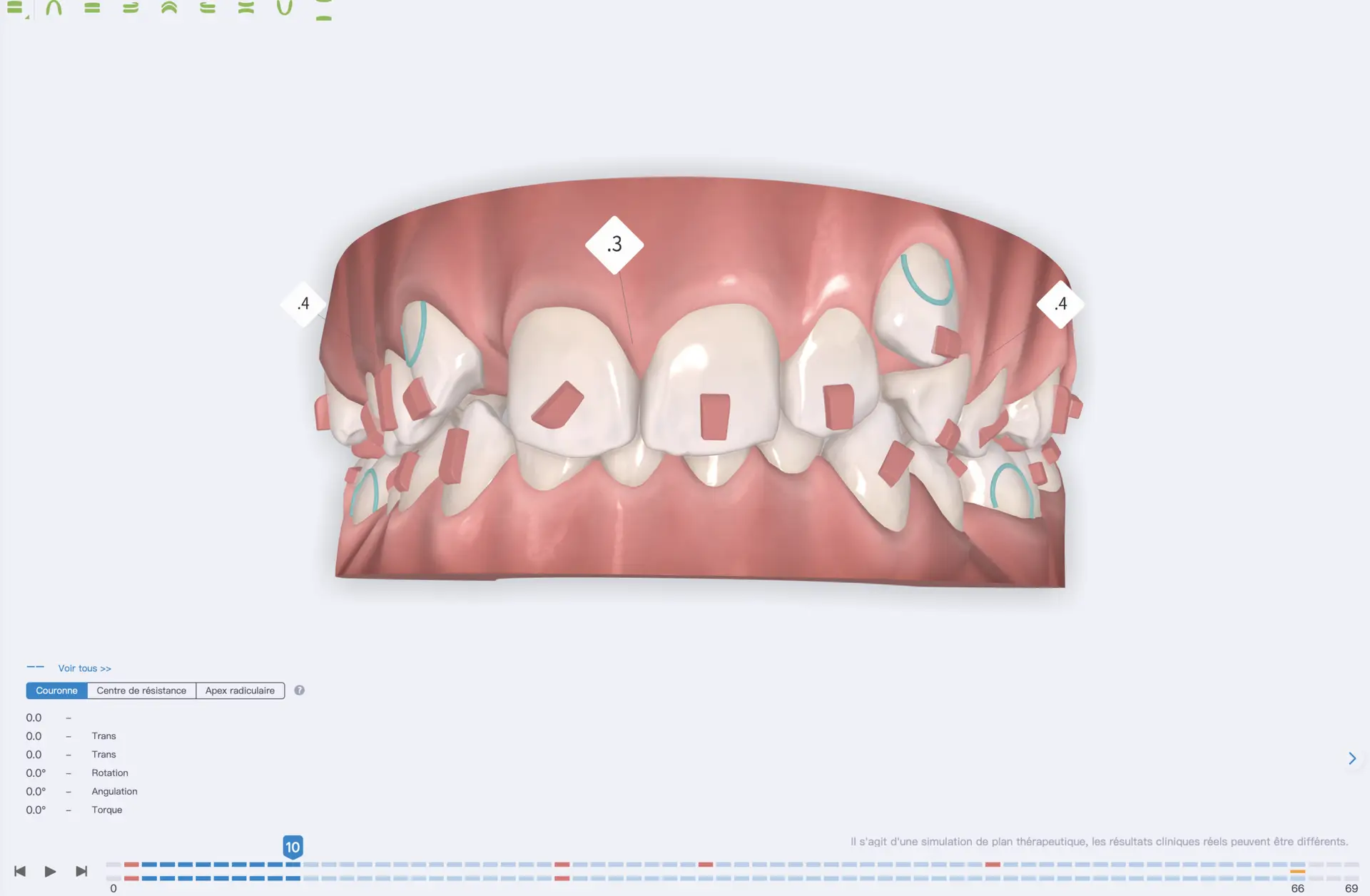 Aligner software