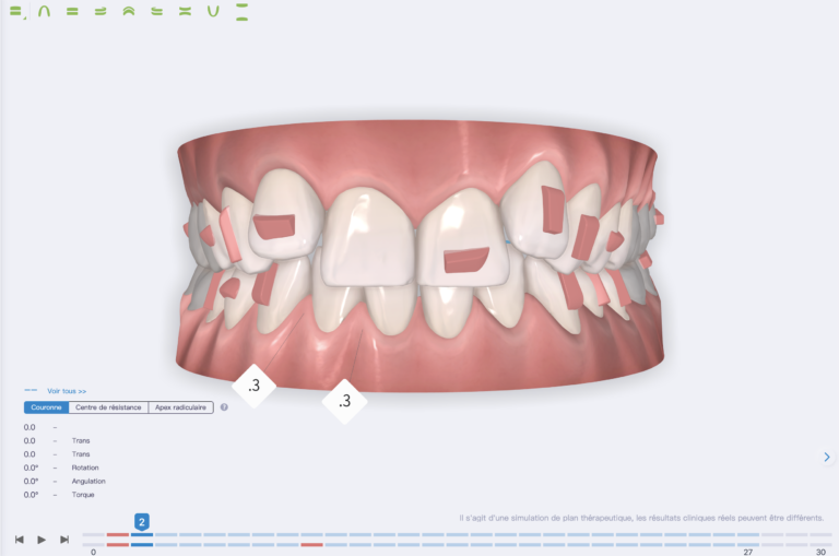 logiciel de planification de traitement orthodontique pour Angel Aligner