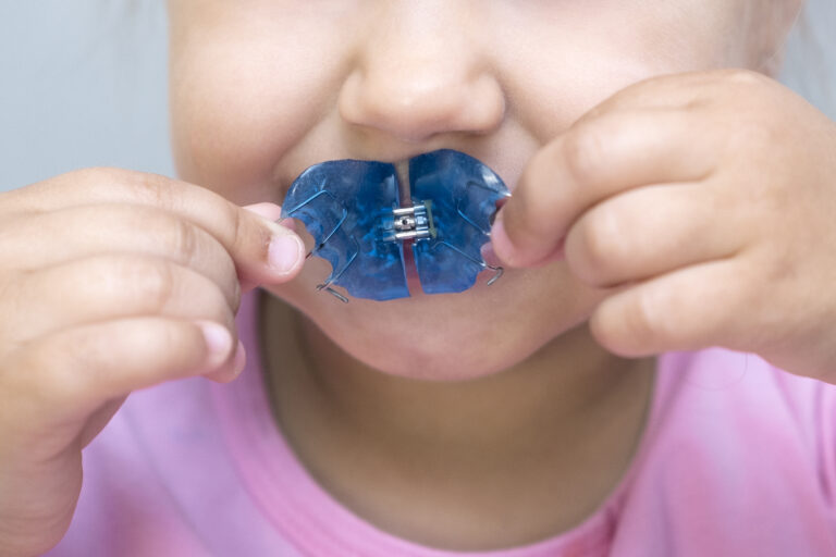 Dental plate. Expansion of the jaw in a child