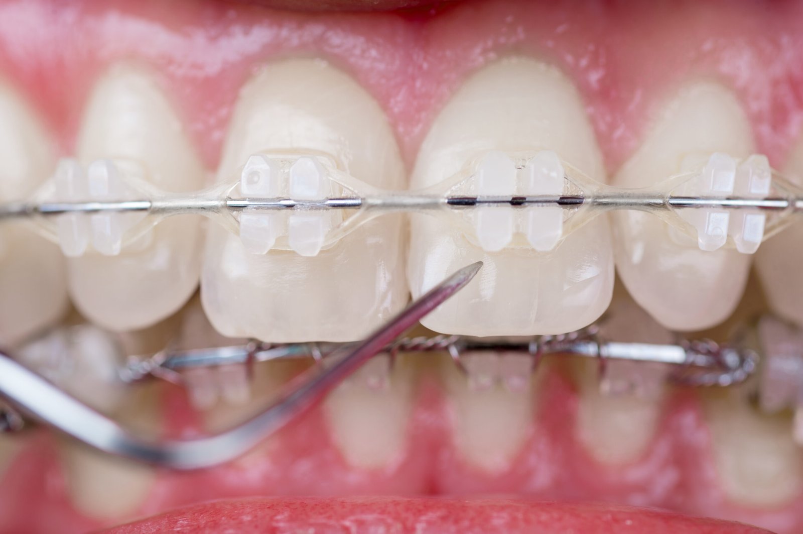 ceramic braces