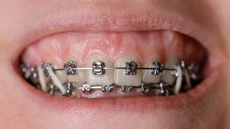 braces treatment presentation